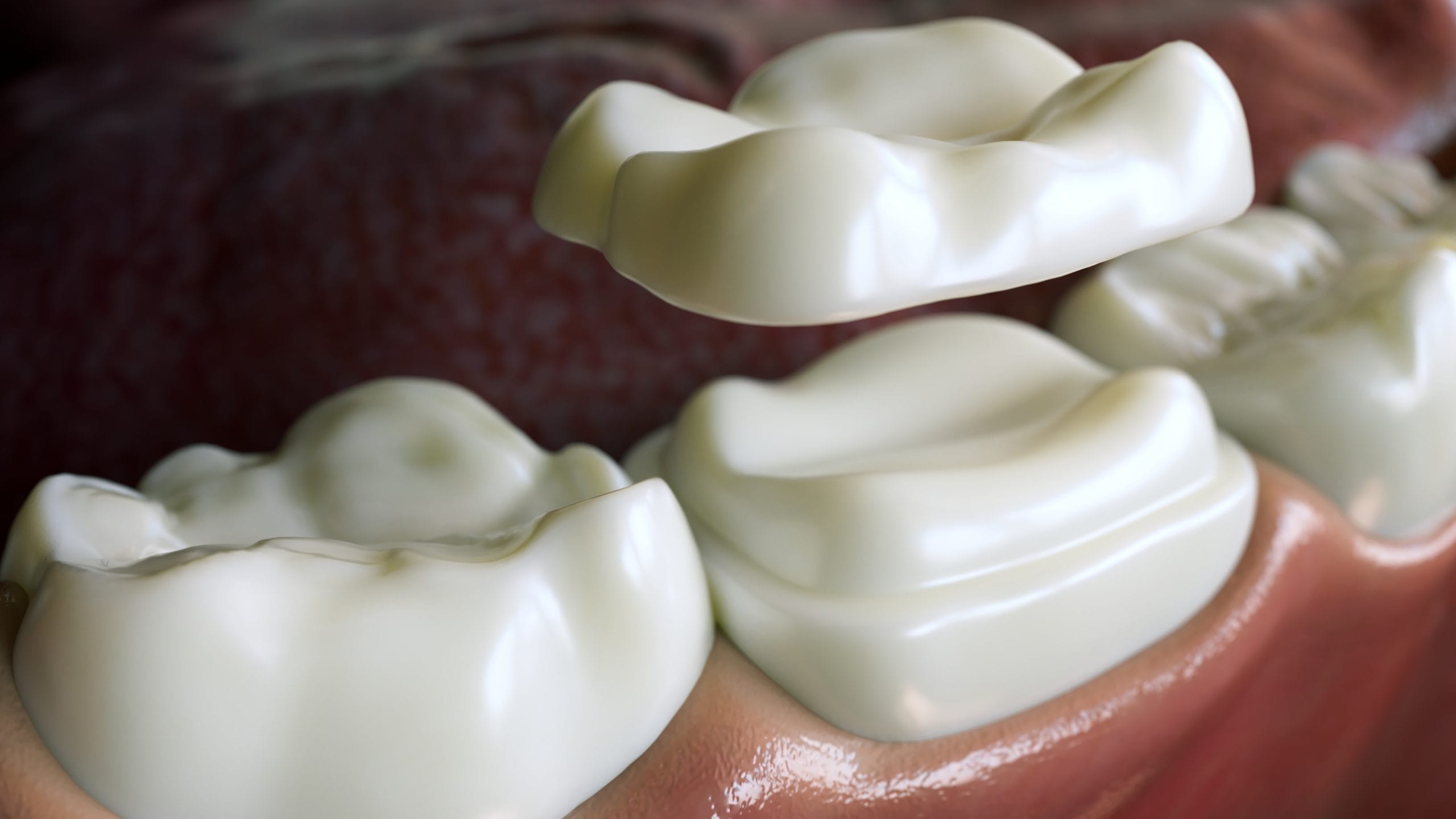 tooth onlay for cracked tooth