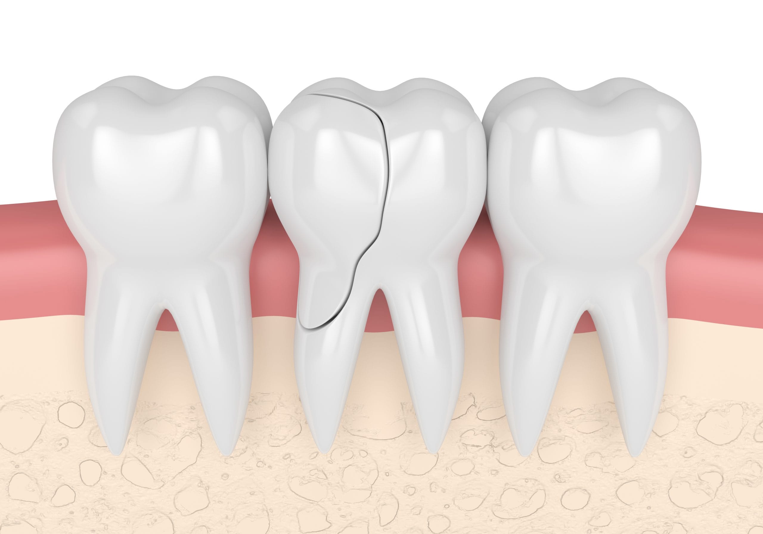 vertical root fracture