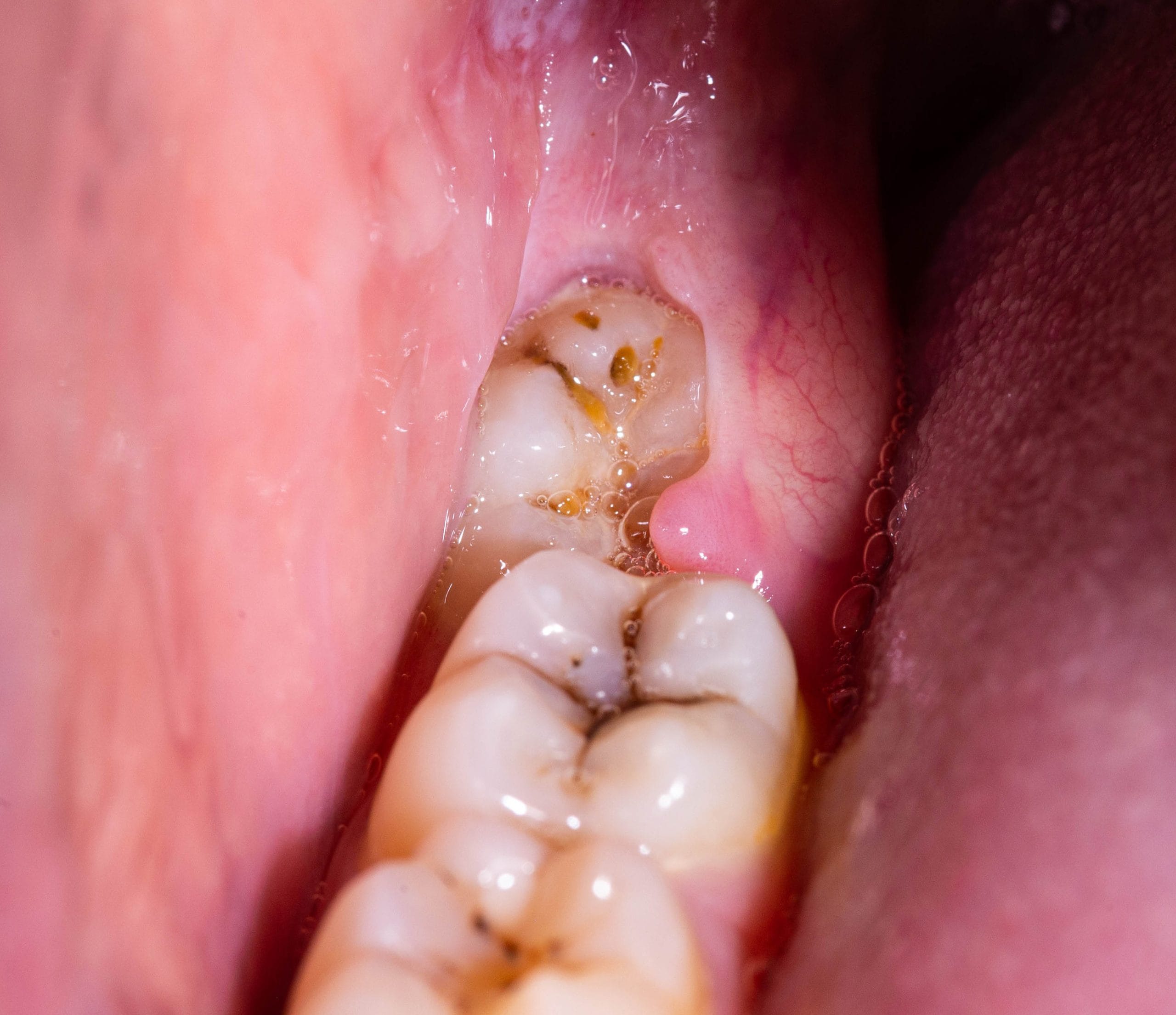 wisdom tooth operculum