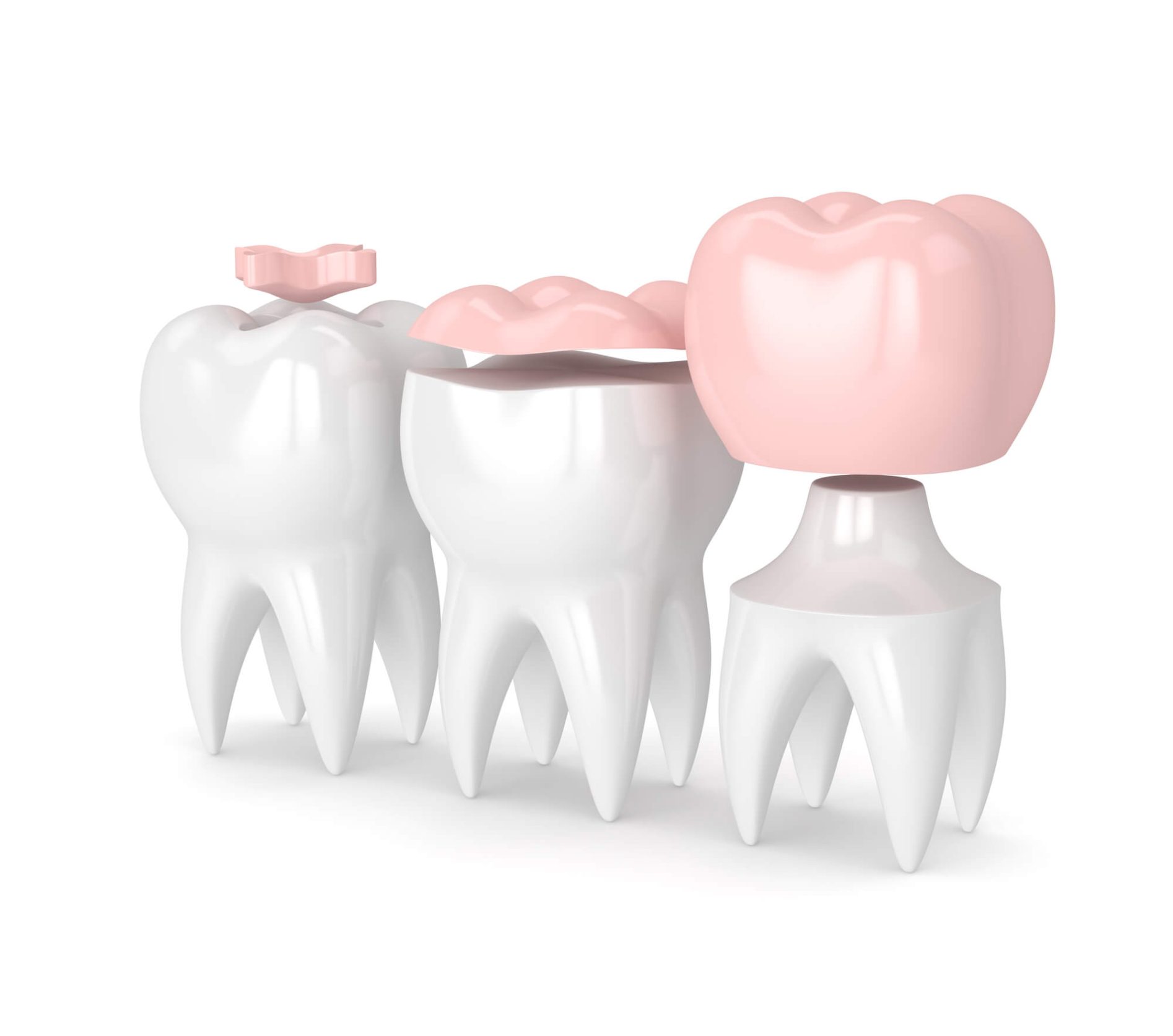 Mercury free dentistry (CEREC)