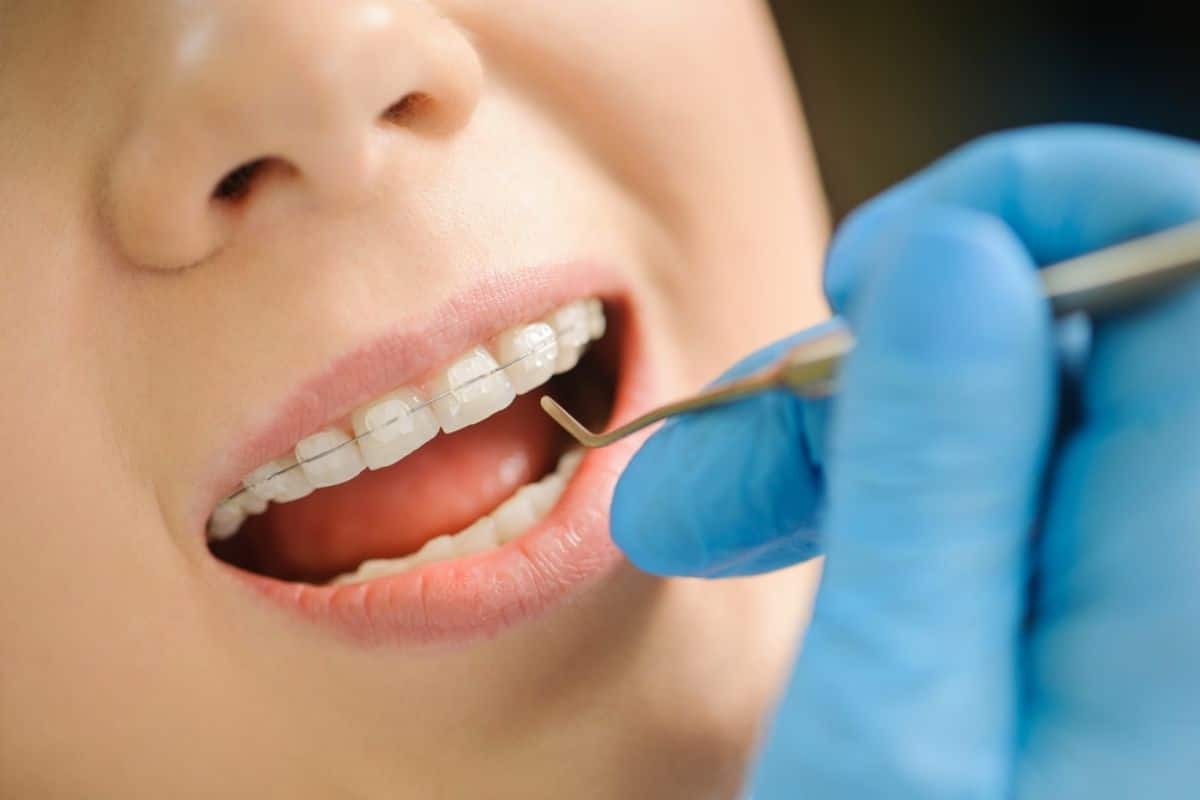 Ceramic Braces