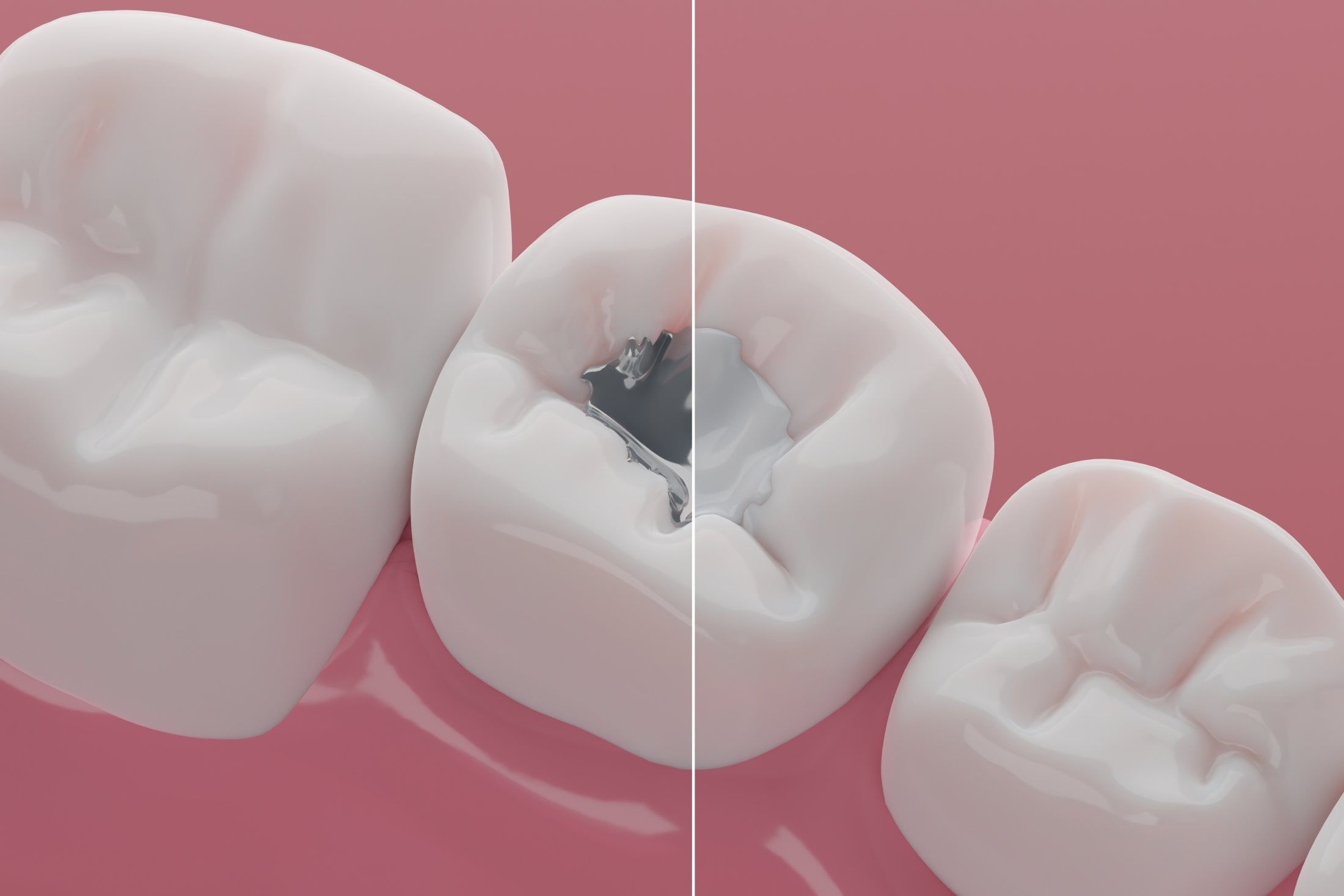 Mercury free dentistry (CEREC)