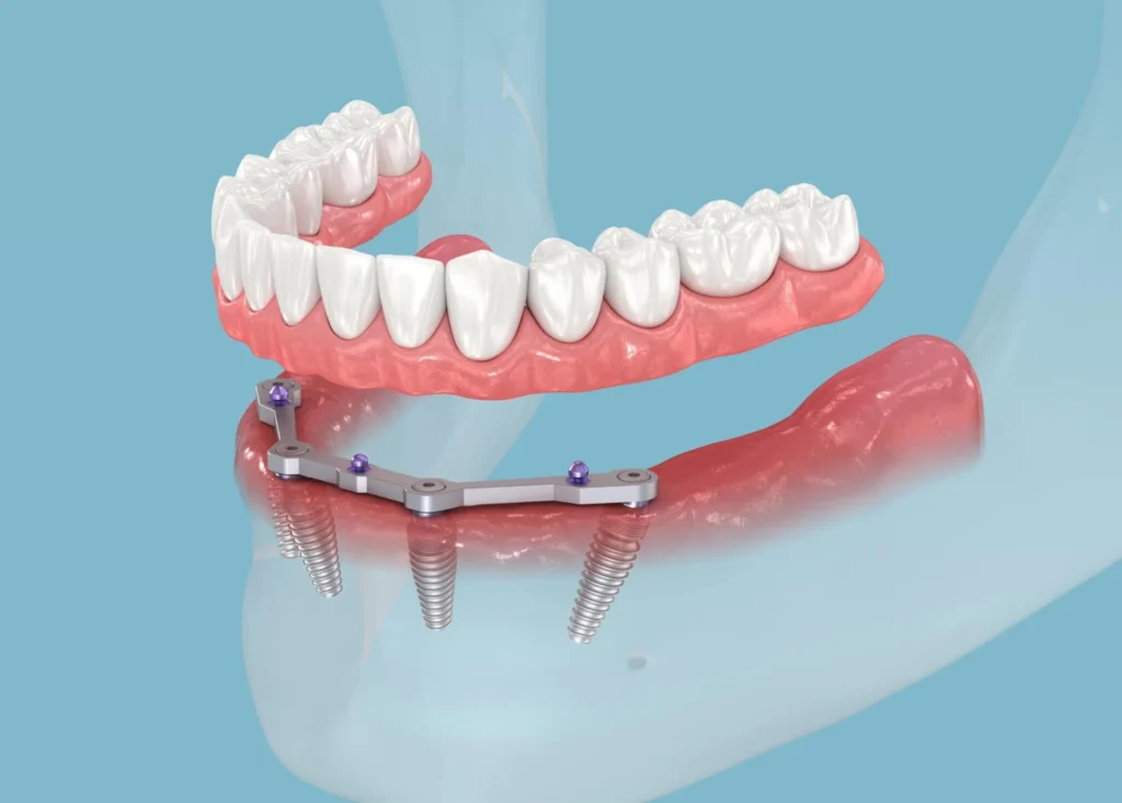 Same-Day Dental Implants
