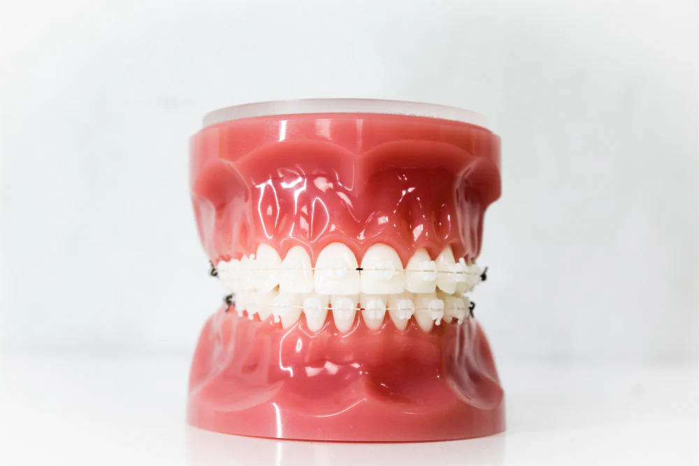 Ceramic Braces