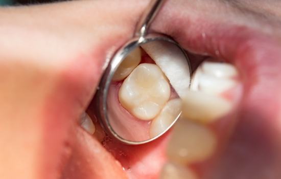 Mercury free dentistry (CEREC)