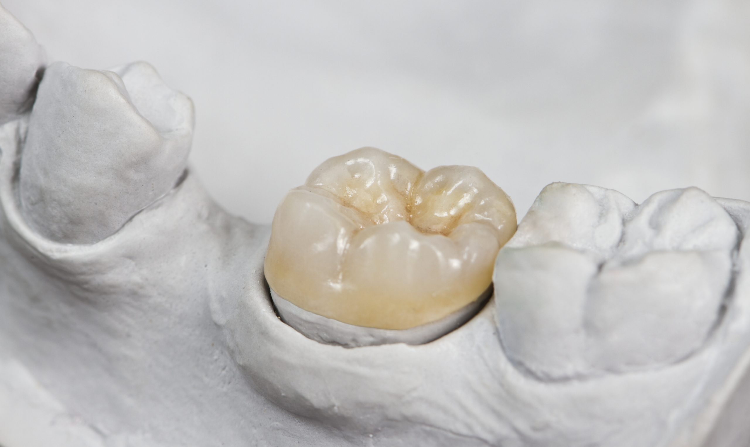 dental onlay/crown