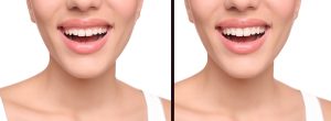 laser gum recontouring