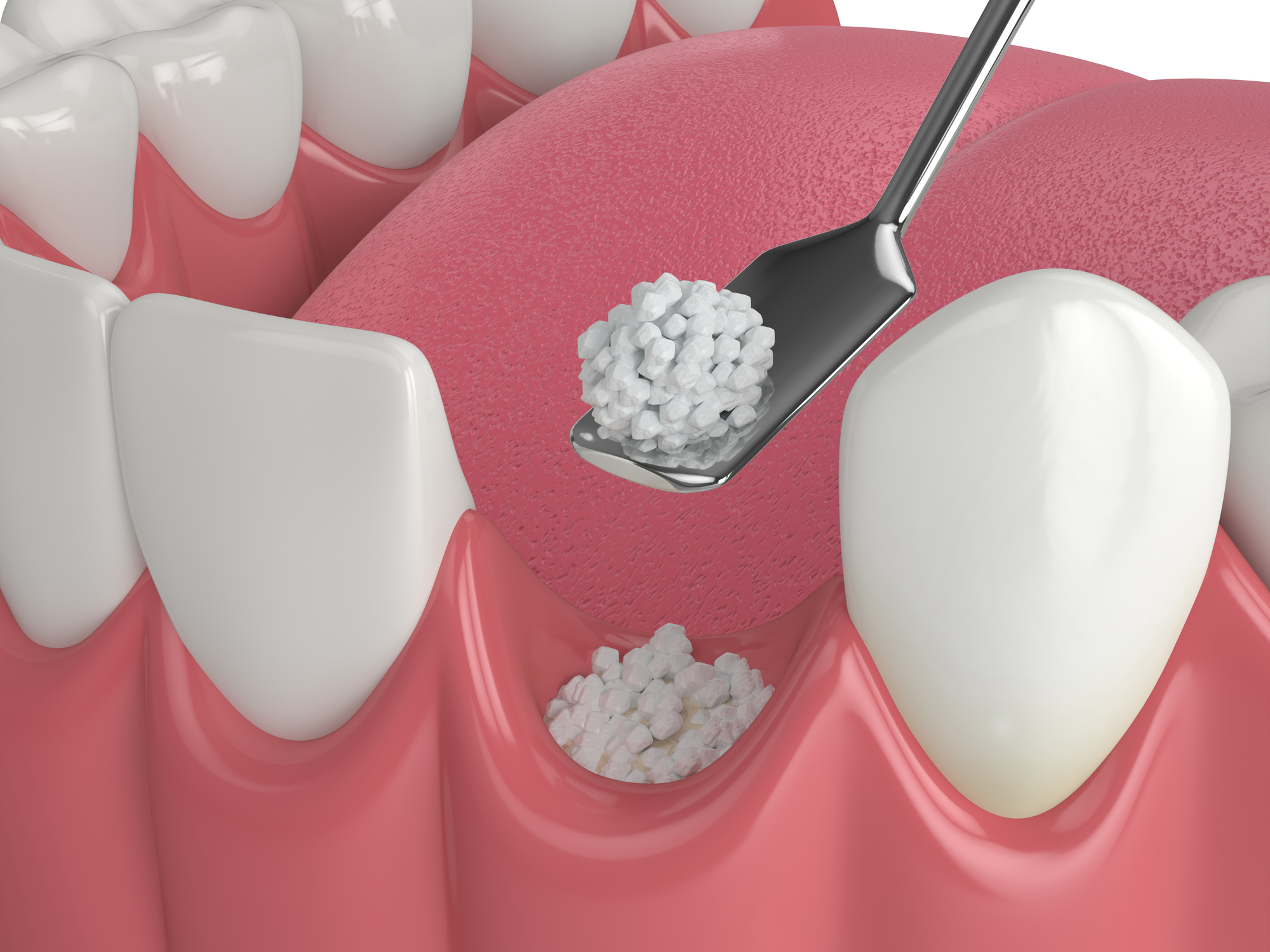Bone Grafts