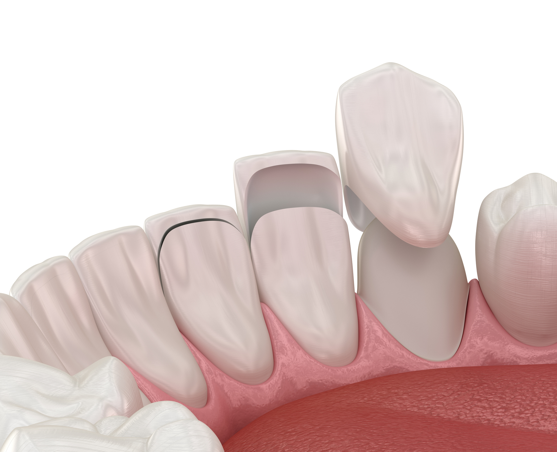 Dental Veneers in Teddington