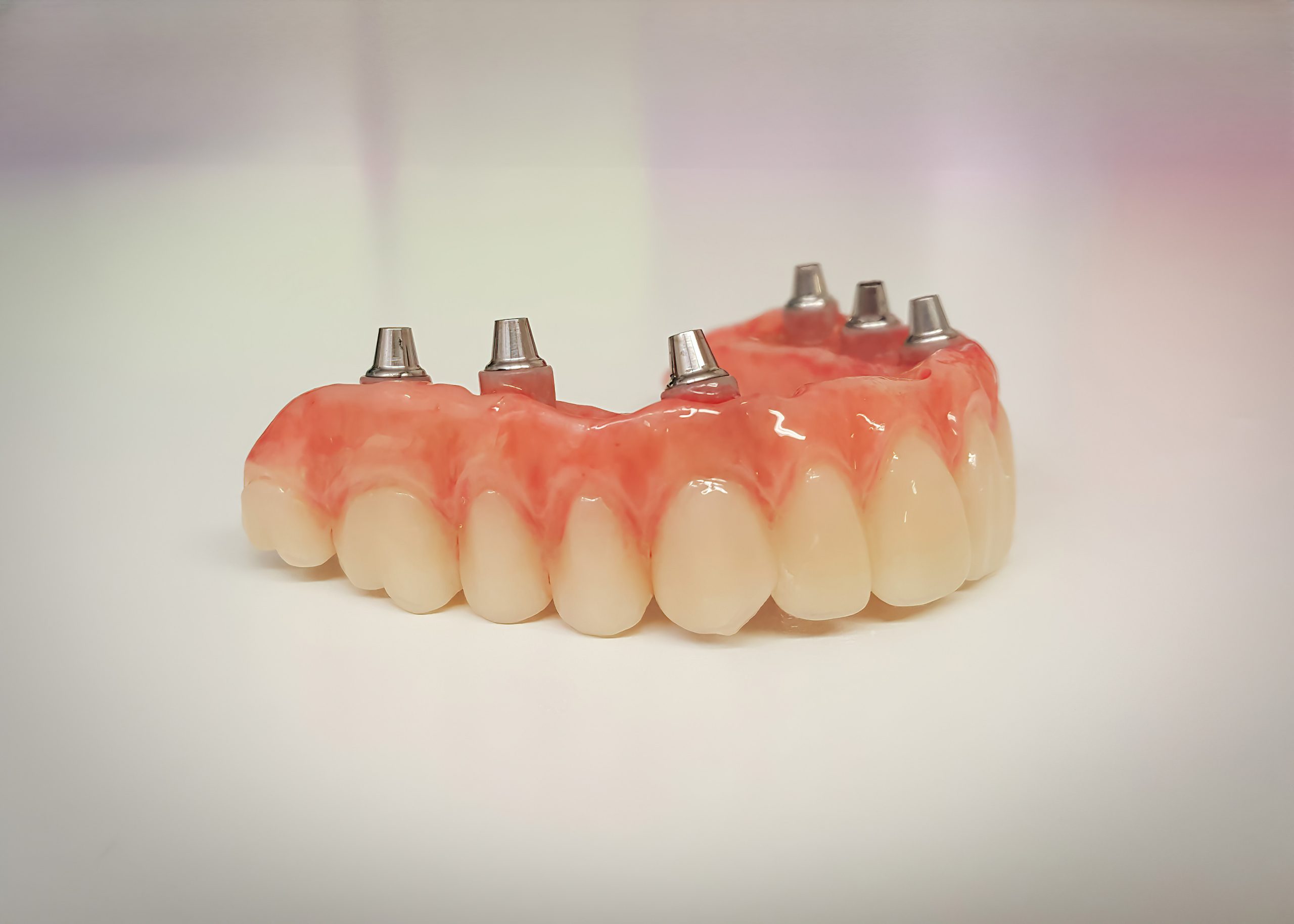 Overdentures