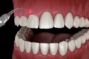 laser dentistry
