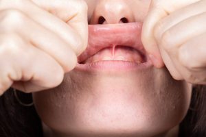 laser frenectomy