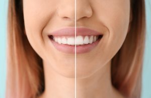 laser gingivectomy