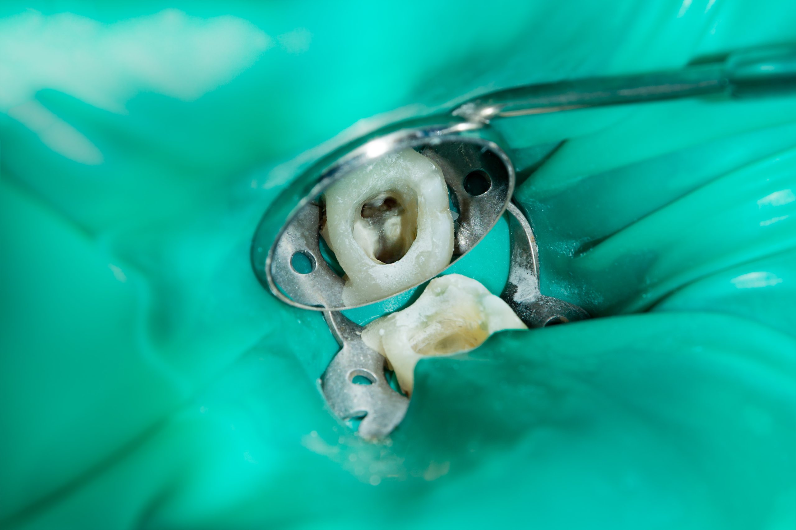root canal treatment