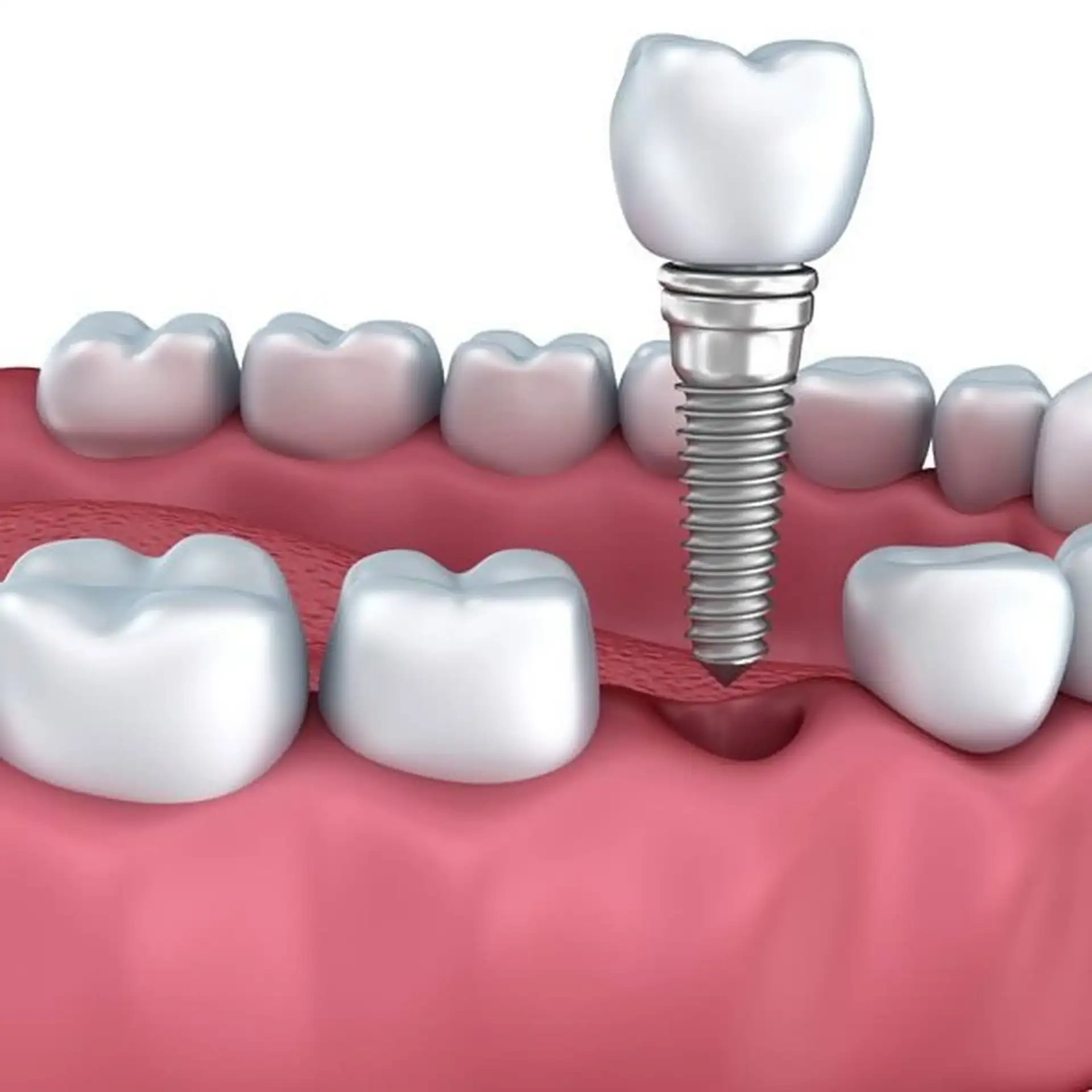 Same-Day Dental Implants