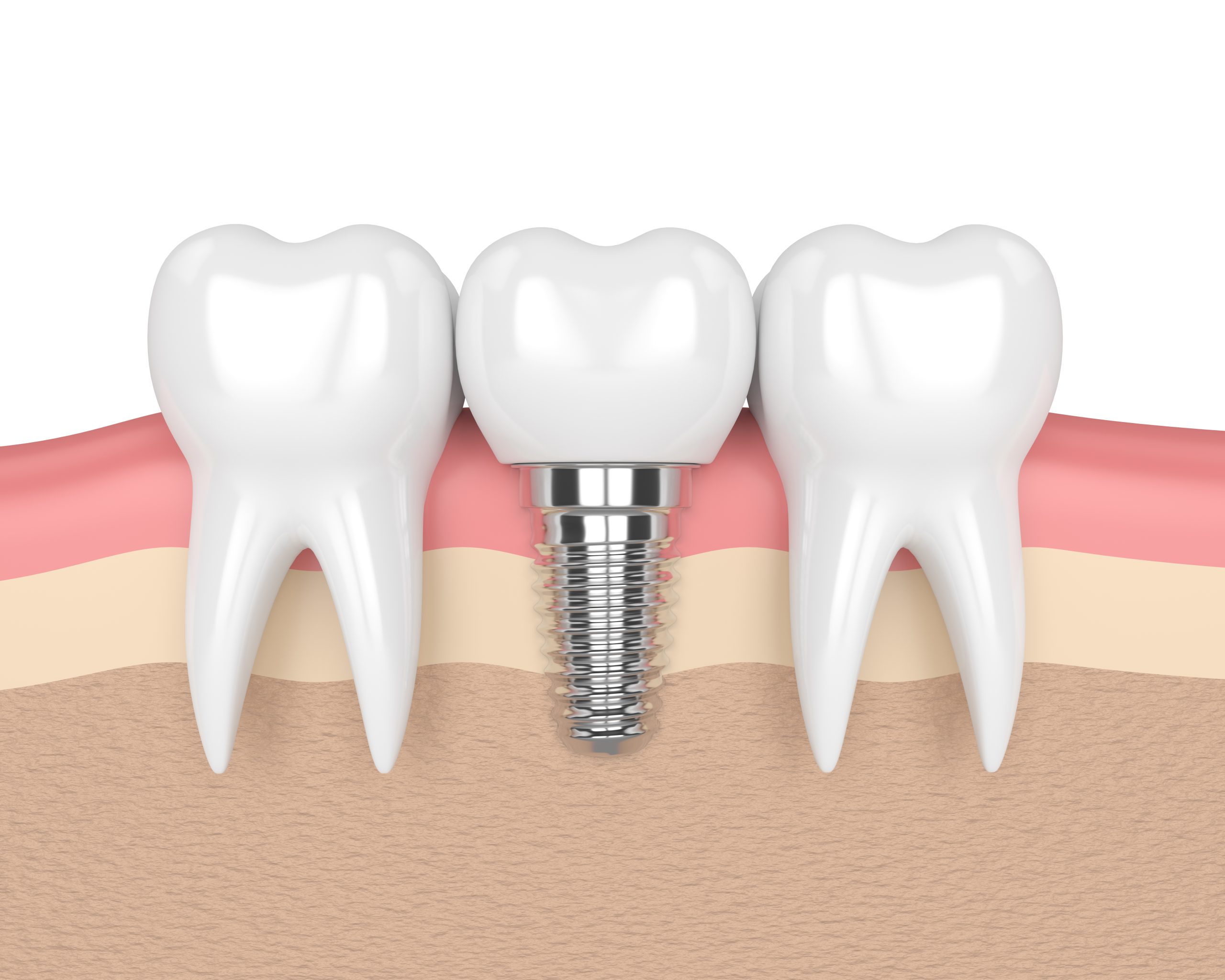 Same-Day Dental Implants