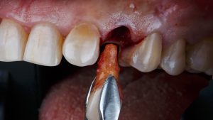 single tooth extraction