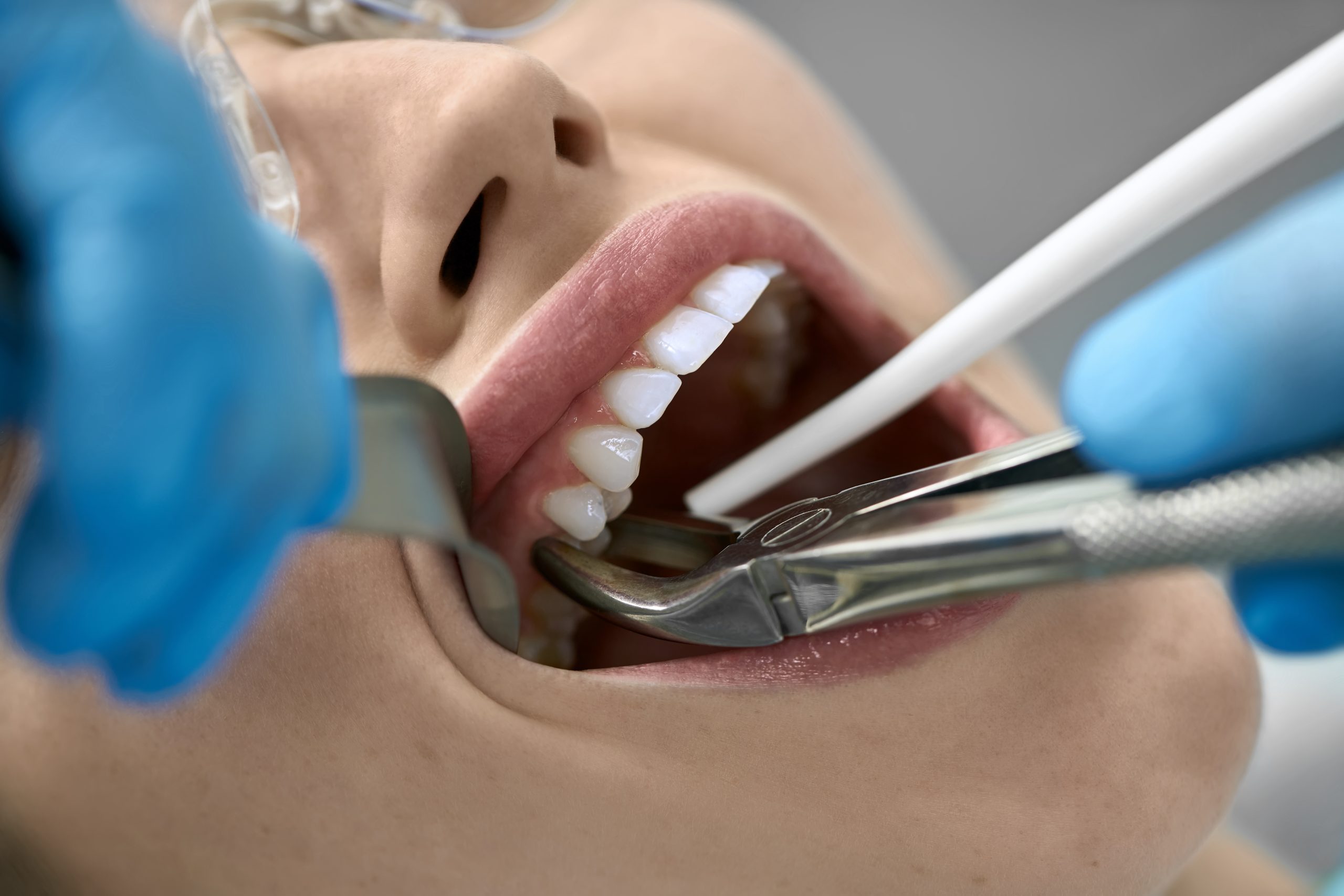 tooth extraction