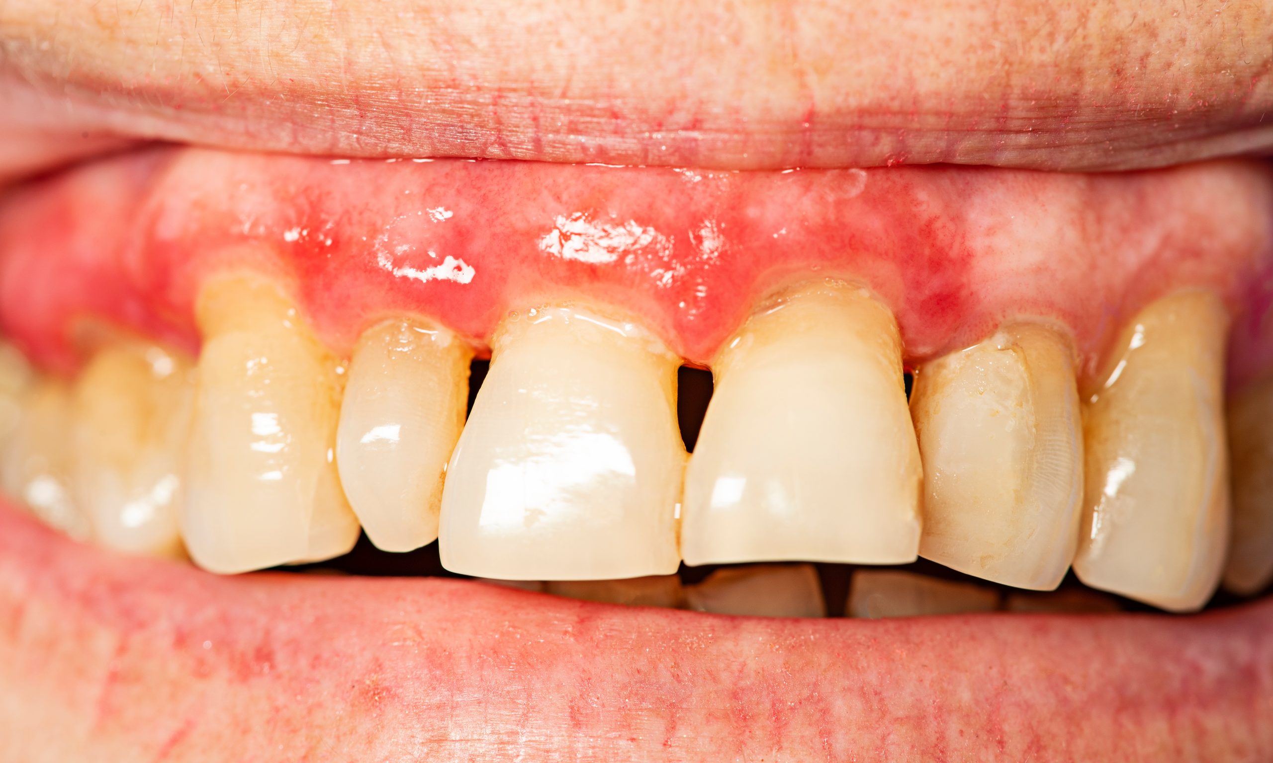 gum periodontal disease