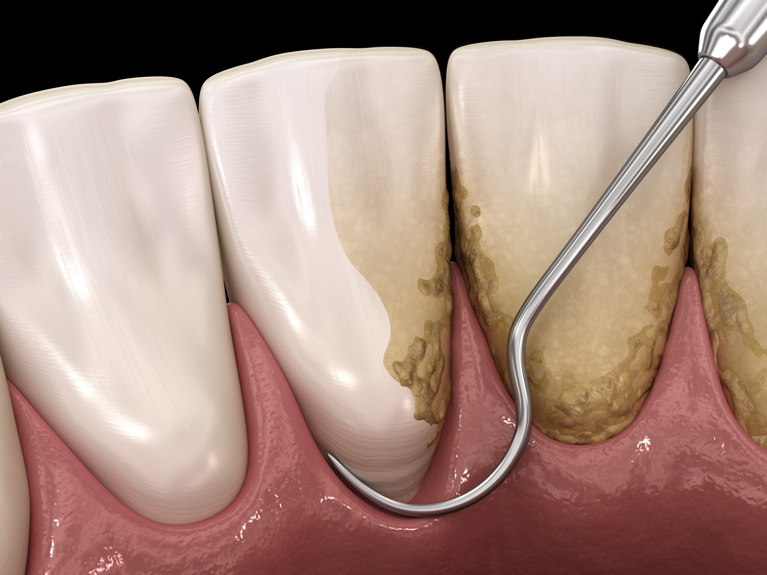 How to Get Rid of Gum Problems: Causes, Treatments and Prevention