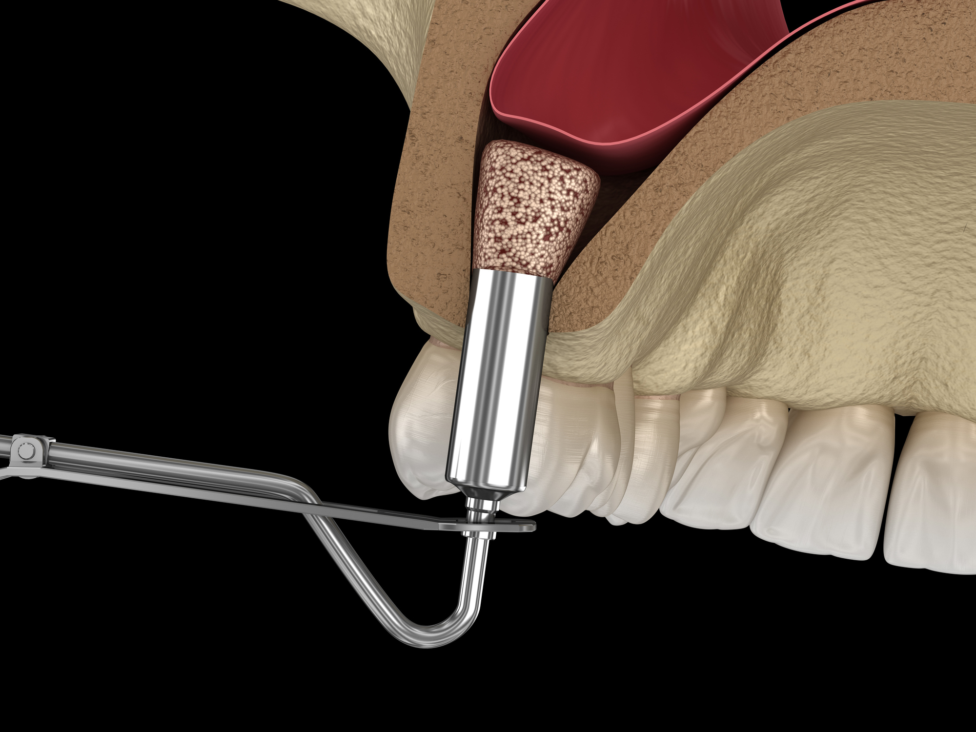 Sinus Lift Surgery