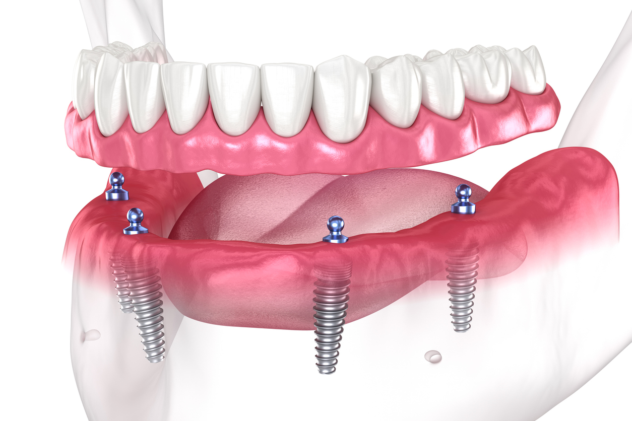 Dental Clips for Missing Teeth: A Fast, Affordable Way to Restore Your Smile
