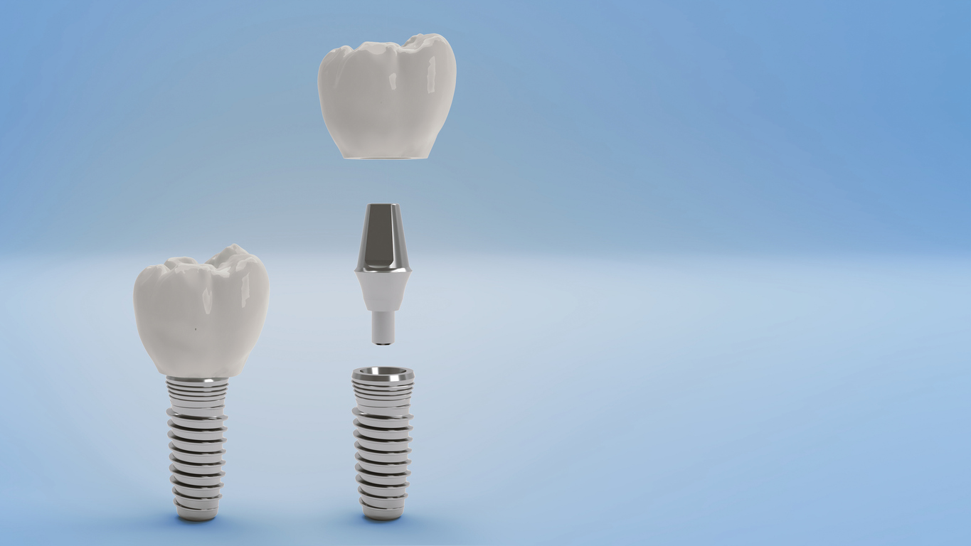 Dental implant post, abutment and crown