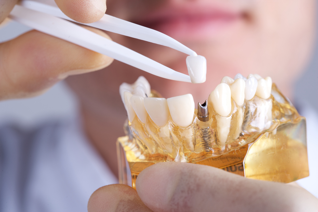 Single implants and teeth-in-a-day options Kingston