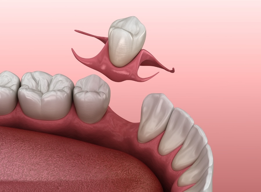Clip-In Missing Teeth