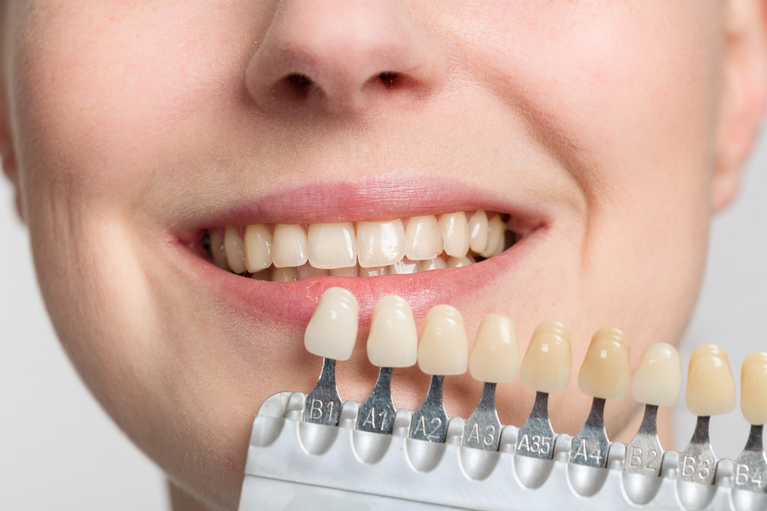 Professional Teeth Whitening in London