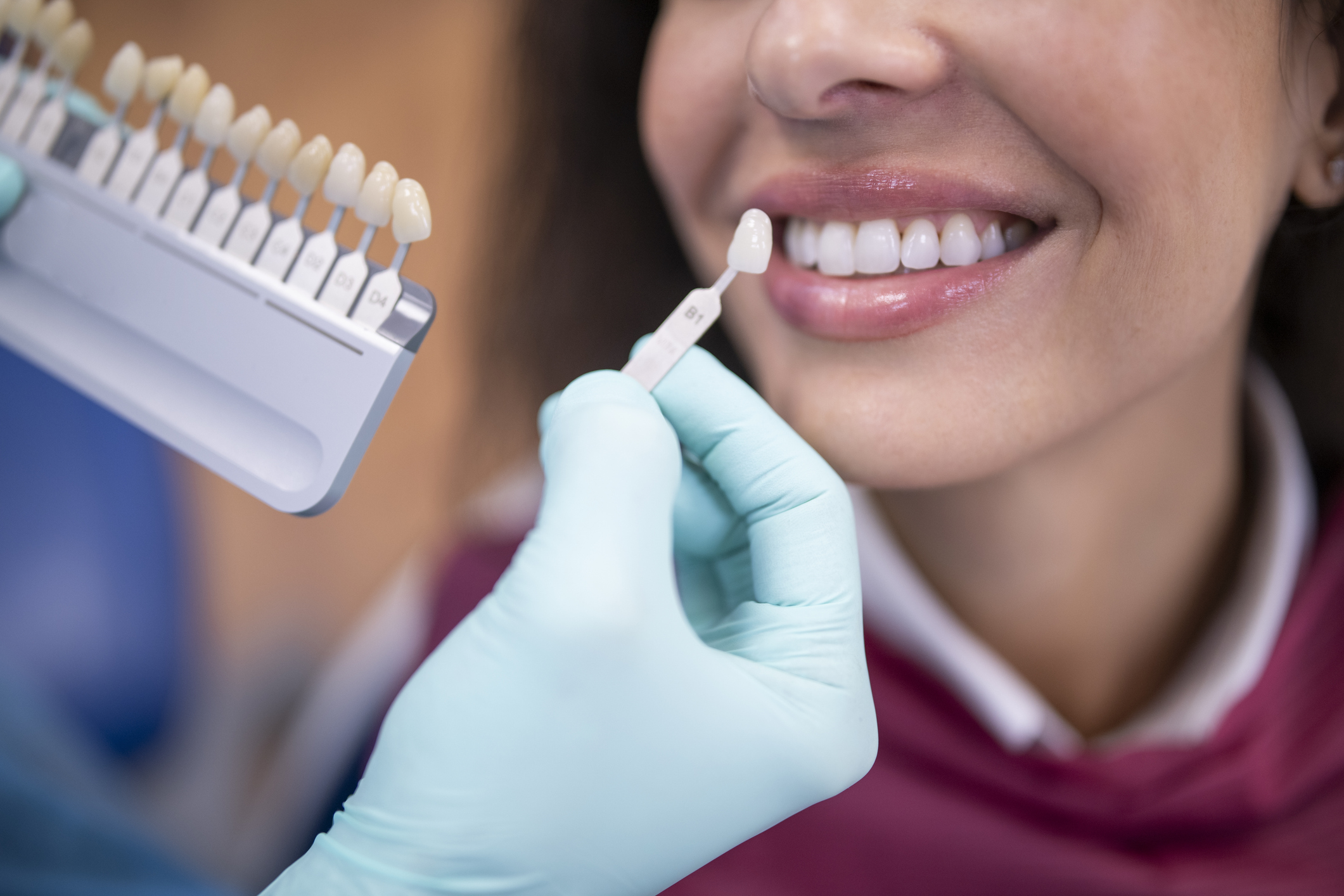 Unlocking your best smile: Everything you need to know about dental veneers
